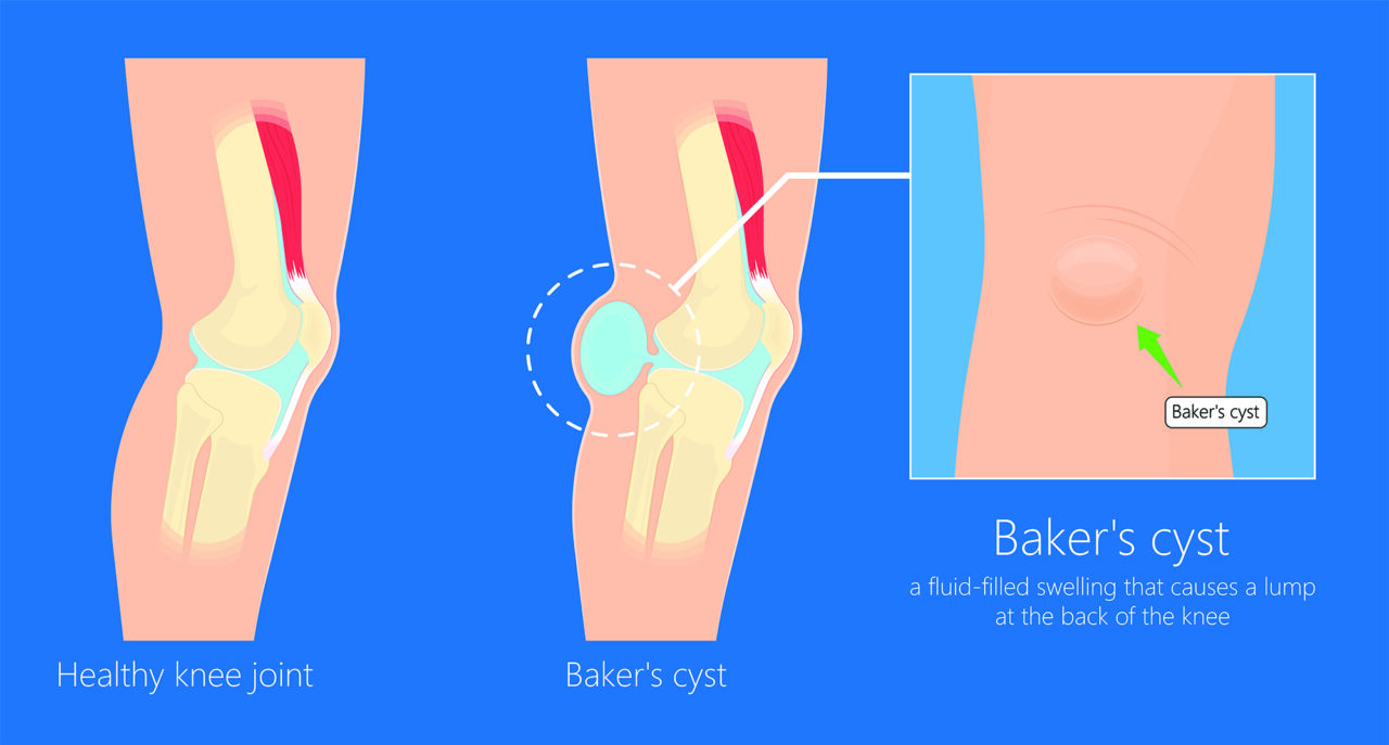 Baker s Cyst